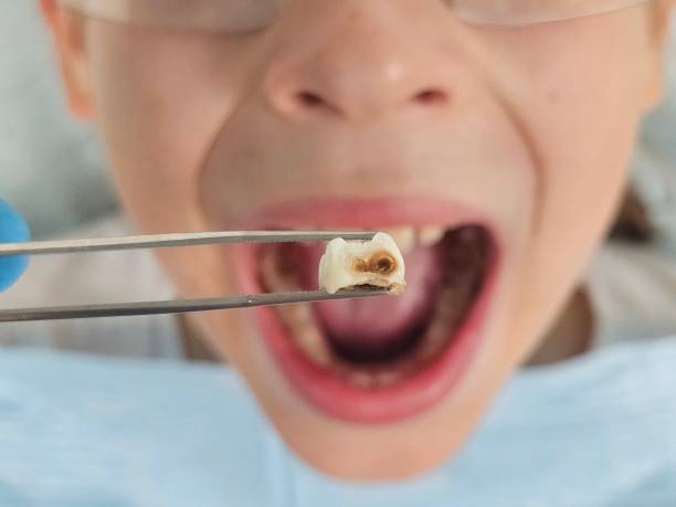 Best Broken or Chipped Tooth Repair in Elleale, ND